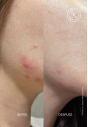 Сироватка від висипань Acnemy Postzit Serum Corrector Marcas Post-Espinillas